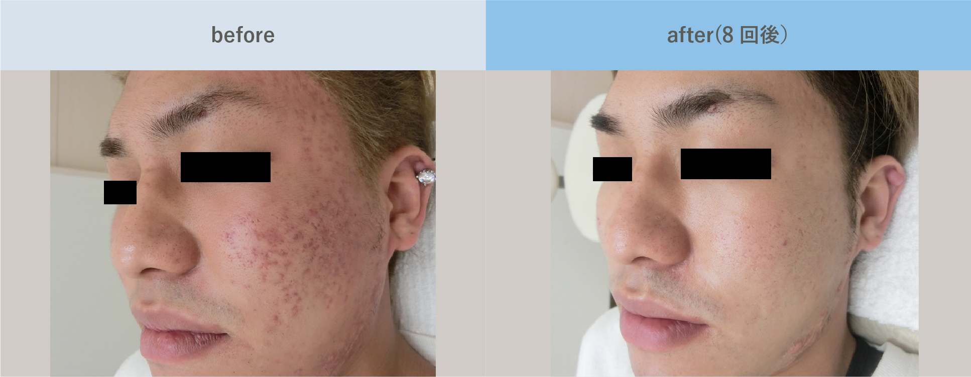 acne