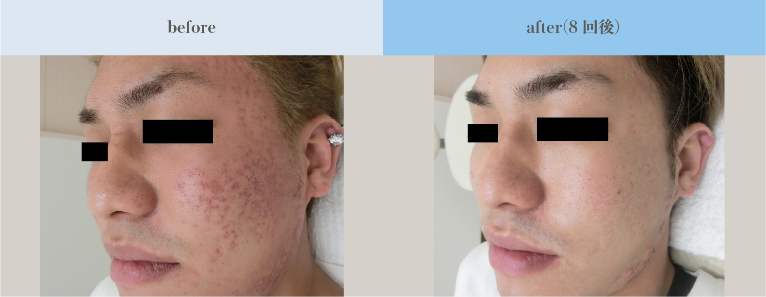Micro fractional laser