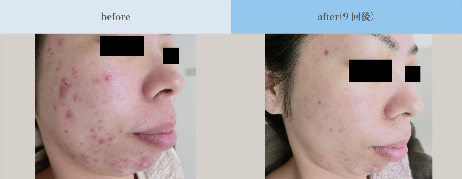Micro fractional laser