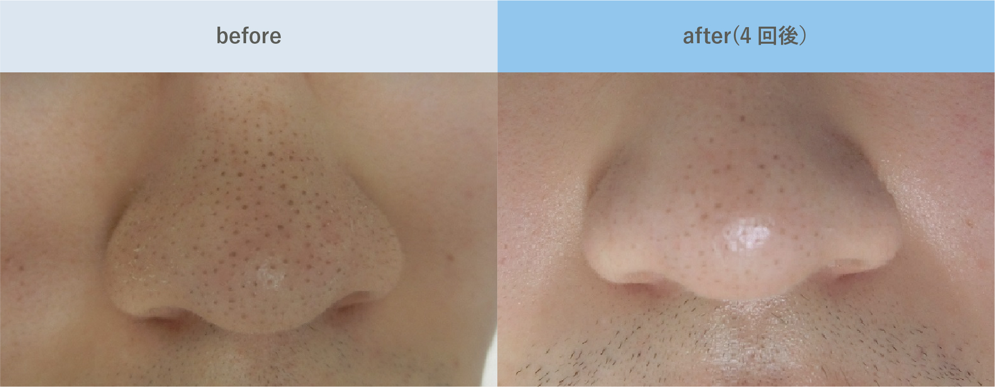 pores